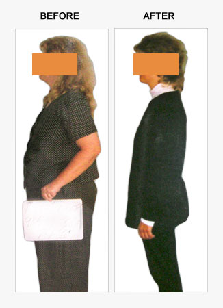 weight loss before and after. Weight loss under medical