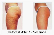 Cellulite Treatment