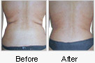 Before and After Mesotherapy Treatment on Back