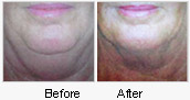 Before and After Mesotherapy Treatment on Neck