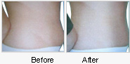 Before and After Mesotherapy Treatment on Stomach