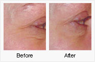 Mesotherapy Before and After